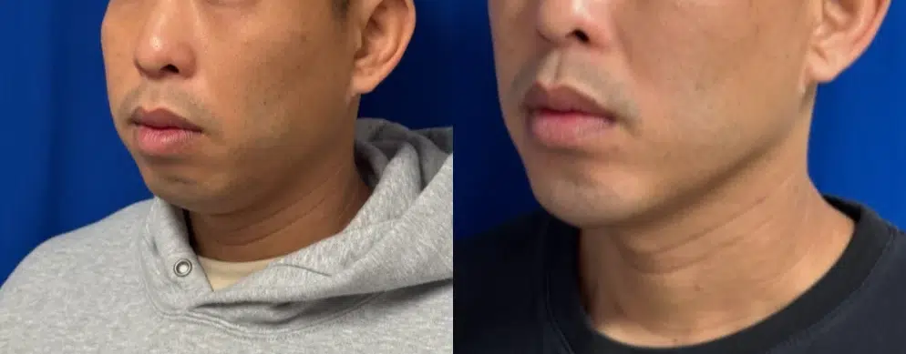 Left Oblique View Chin Implant before and after by Faceology MD