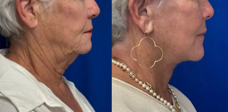 Left Side View Facelift and CO Laser before and after by Faceology MD
