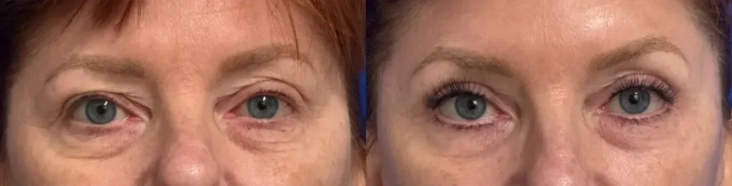 Front View Eyelid Surgery before and after by Faceology MD