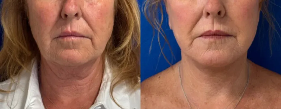 Front View Facelift before and after by Faceology MD
