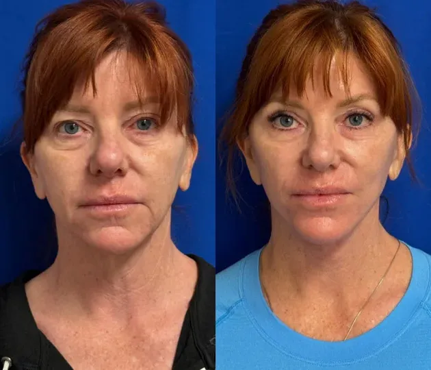 Front View Facelift before and after by Faceology MD