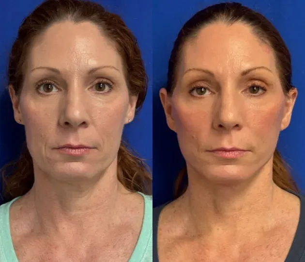 Front View Facelift before and after by Faceology MD
