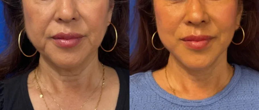 Front View Facelift before and after by Faceology MD